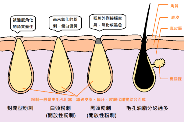 黑頭粉刺-白頭粉刺